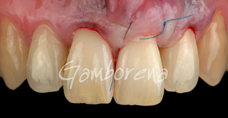 Periodoncia Injerto En Dientes Clínica Dental Dr. Gamborena - Dr. Gamborena